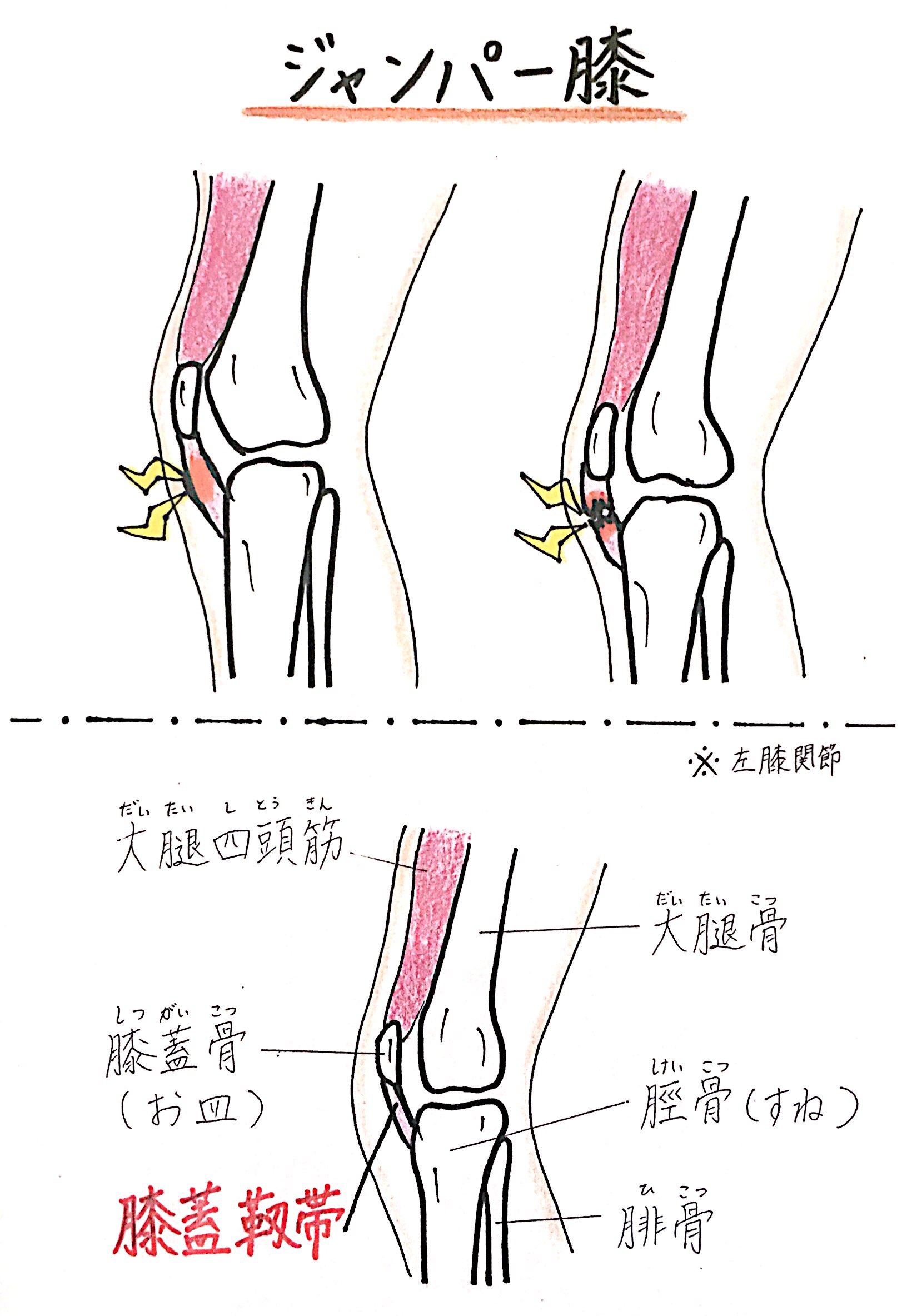 ジャンパー膝(膝蓋靭帯炎)について｜高砂 まえかわ整骨院 | 高砂市JR宝殿駅まえかわ整骨院
