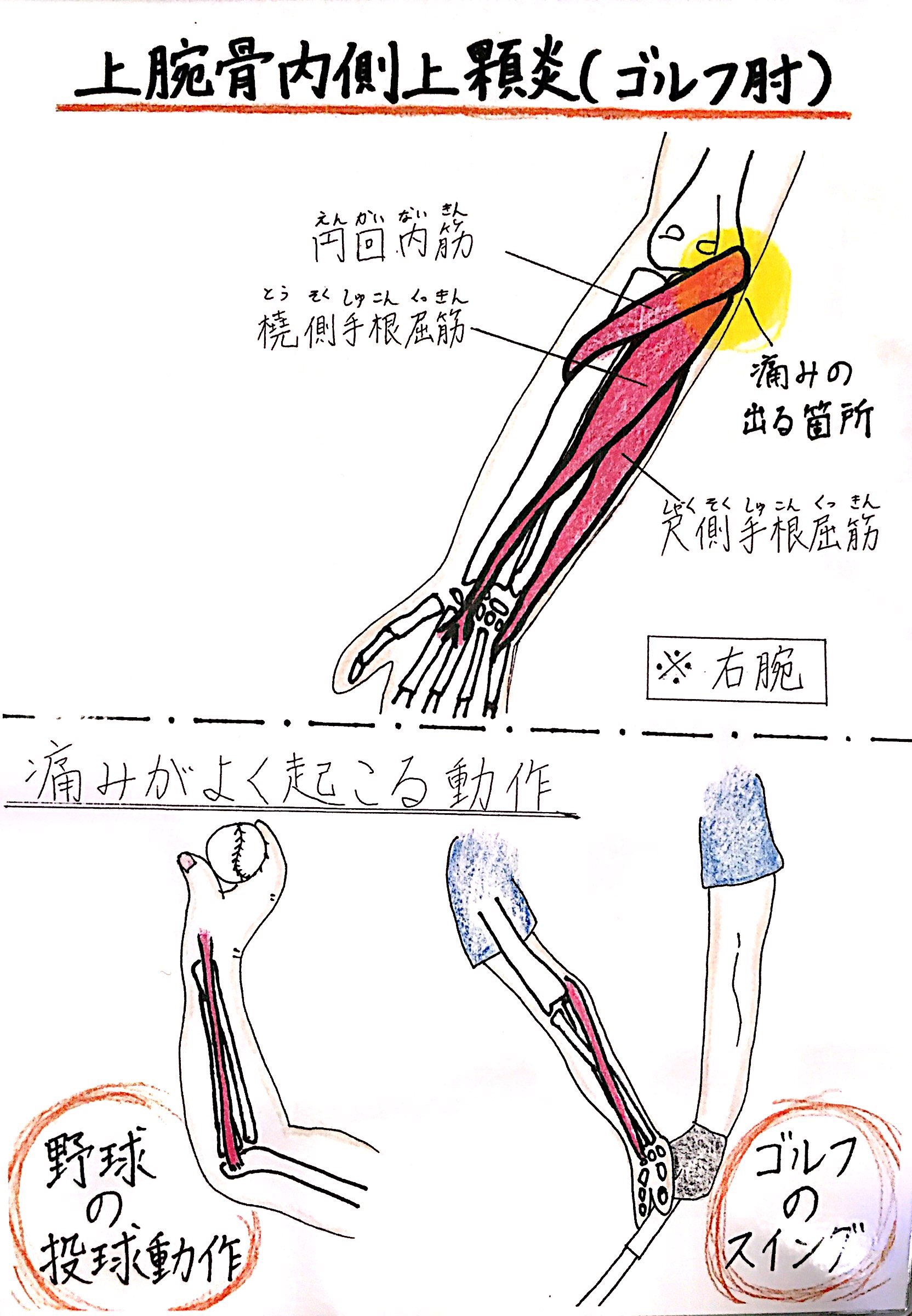 内側 上 顆 炎